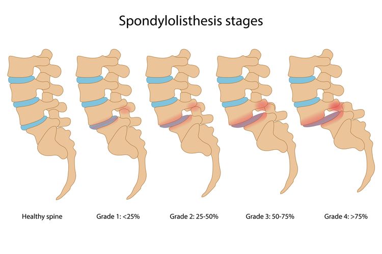 Ilustrasi Spondylolisthesis