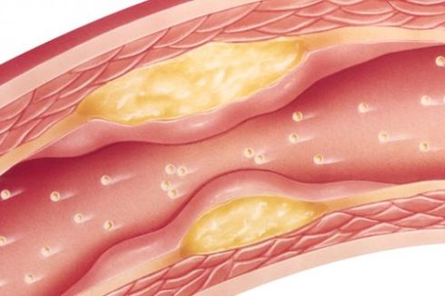 Kenali Apa itu Aterosklerosis, Penyebab Serangan Jantung sampai Stroke