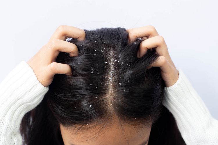 Sensitif terhadap produk perawatan rambut tertentu adalah salah satu penyebab timbul ketombe.