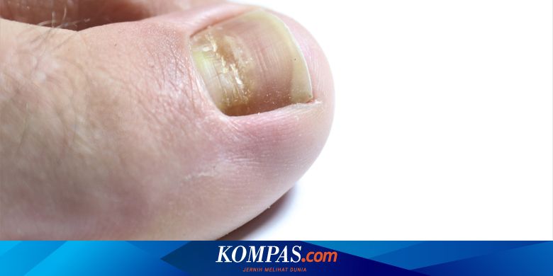 Perubahan Pada Kuku Bisa Jadi Tanda Terinfeksi Covid 19