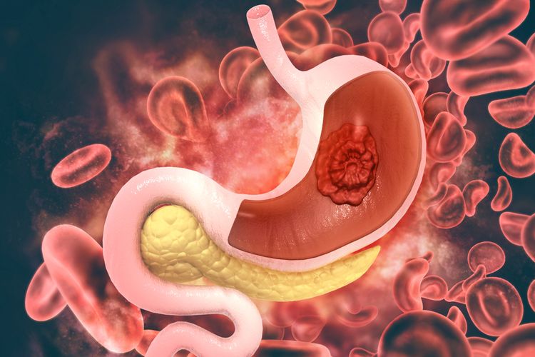 Gastritis Merupakan Panyakit Karena Gangguan ? : Gastriris ...