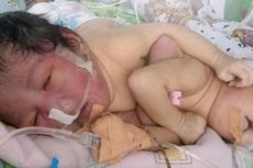 Seorang Ibu Melahirkan Bayi Kembar Siam Perut di Kamar Mandi