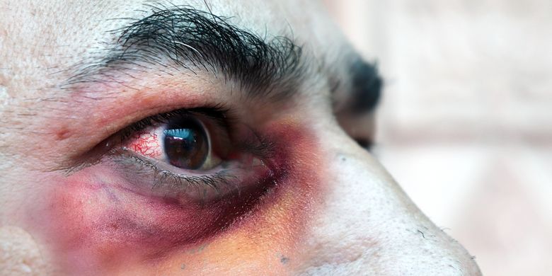 Ilustrasi mukormikosis. Usai Covid-19, seorang pria di India terinfeksi mukormikosis yang disebabkan oleh jamur hitam. Penyakit ini menyerang daerah mata.