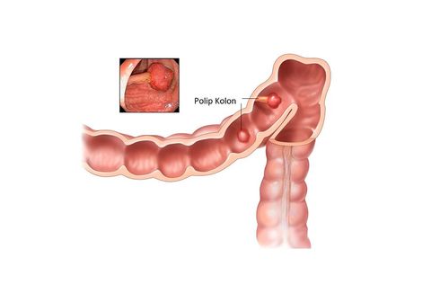 Gejala Kanker Kolon dan Bagaimana Mencegahnya Sejak Dini