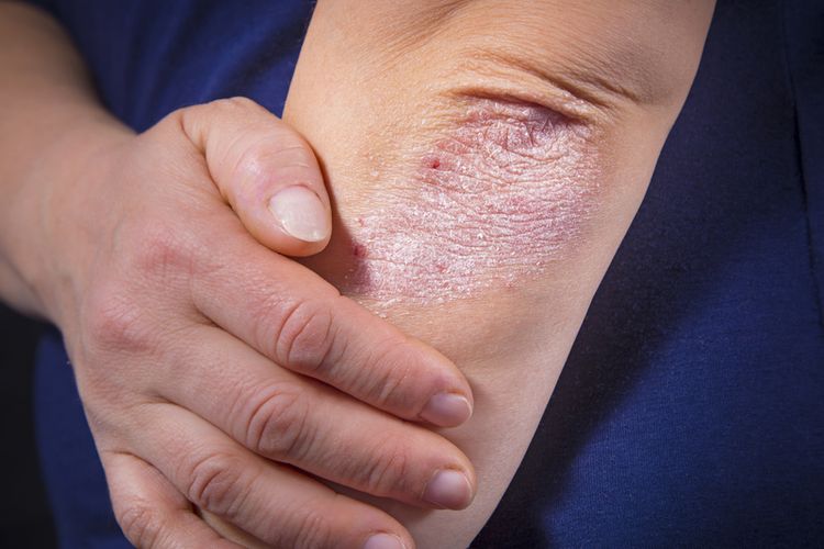 Cara menghilangkan gatal pada kulit yang tidak kunjung sembuh