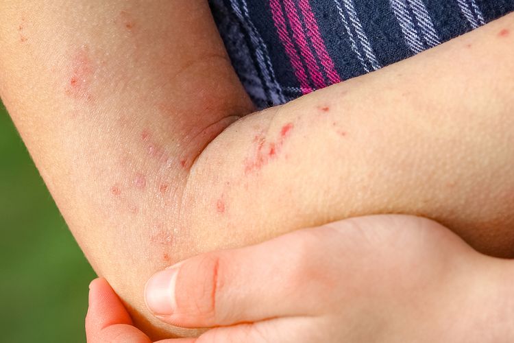Alergi juga bisa menyebabkan kulit kering atau dikenal sebagai kontak dermatitis.