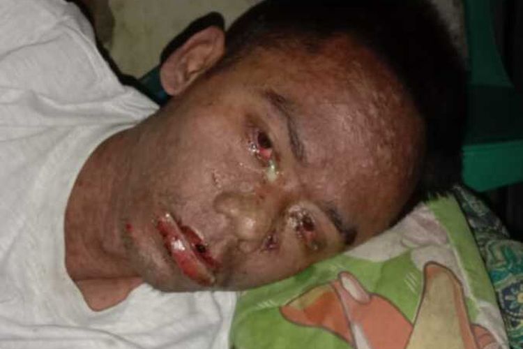 Zaenal Abidin (27), orang dengan gangguan jiwa (ODGJ) tersebut tubuhnya melepuh. Hasil pemeriksaan dokter ditemukan indikasi akibat pengaruh alkohol.