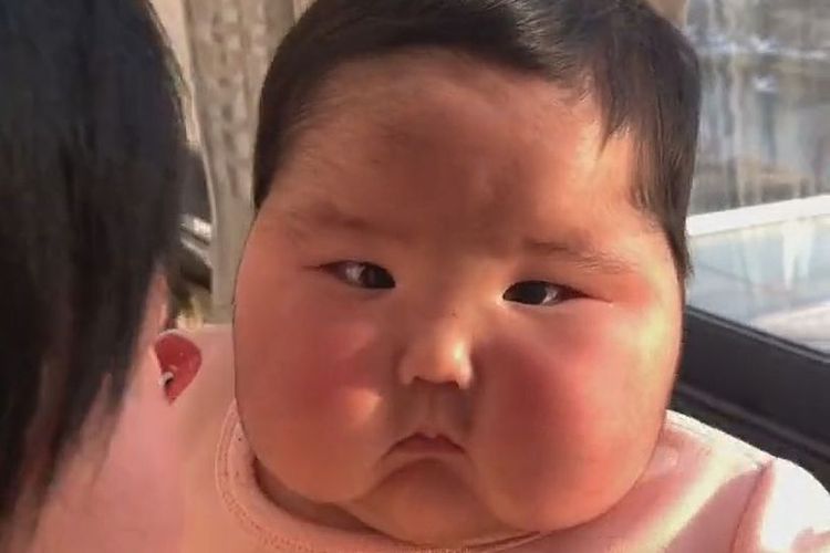 Bayi di China yang pipinya menggelembung dan rambutnya muncul setelah mendapatkan krim steroid.