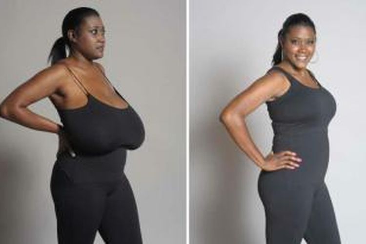 Kerisha Mark, sebelum dan sesudah operasi yang mengurangi ukuran payudaranya.