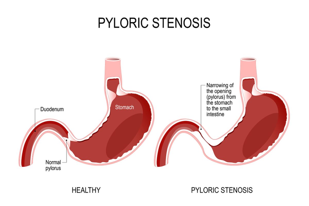 Ilustrasi Stenosis Pilorus