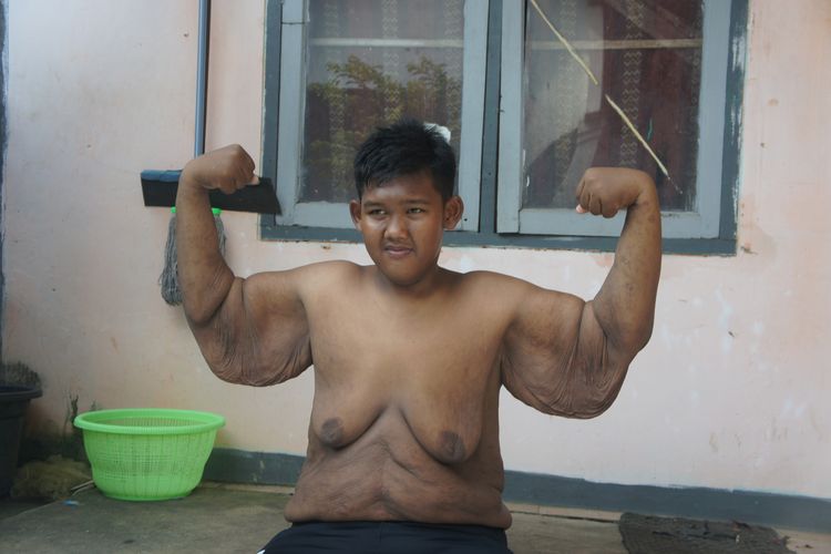 Arya Permana, bocah asal Karawang yang berat badannya sempat 192 kilogram, kini turun menjadi 85 kilogram saat ditemui Kompas.com di rumahnya, Desa Cipurwasari, Kecamatan Tegalwaru, Kabupaten Karawang, Selasa (18/6/2019). Arya kini gemar berenang serta bermain sepakbola. 