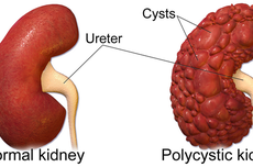 Tanda-tanda Penyakit Ginjal Polikistik yang Bisa Akibatkan Gagal Organ