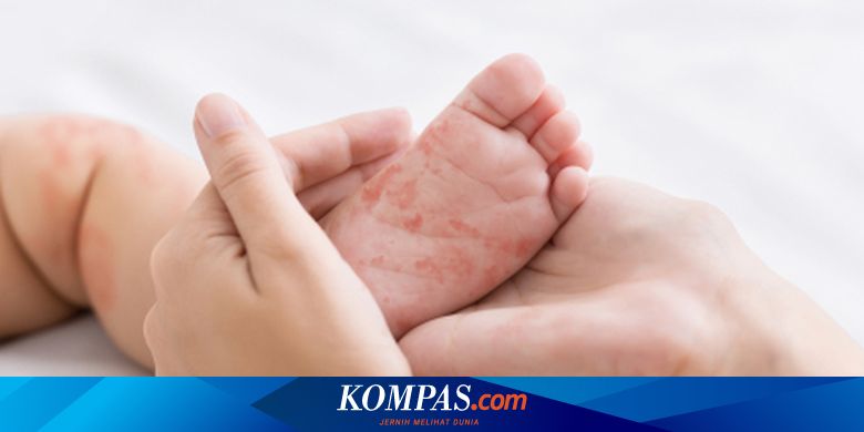 Waspada Campak Merebak, Sudinkes Jakbar Imbau Orang Tua Segera Imunisasi Anak