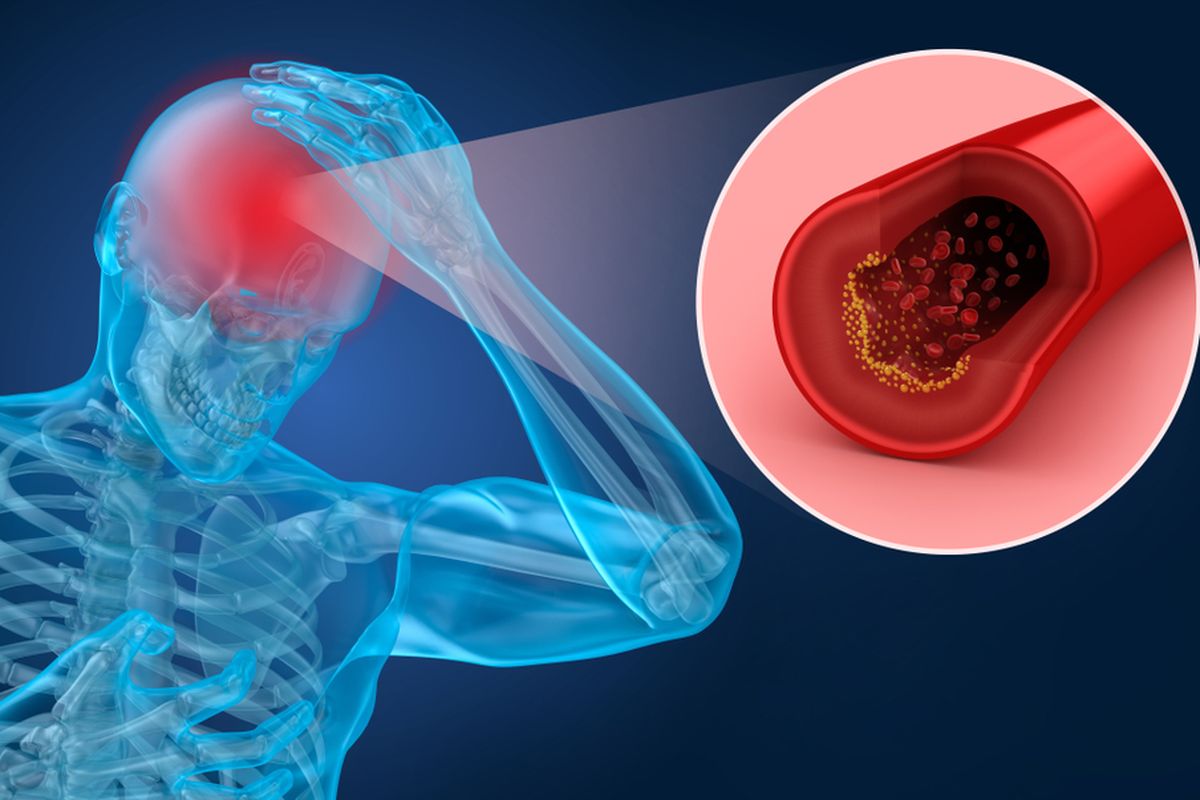 Stroke disebabkan oleh adanya penumpukan plak (aterosklerosis) di arteri otak. 