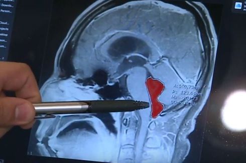 Mengeluh Sakit Kepala hingga Muntah, Ternyata Ada Cacing Pita di Otak Pria Ini