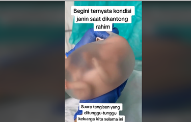 Mengenal Kelahiran En Caul, Saat Bayi Lahir Masih Terbungkus ...
