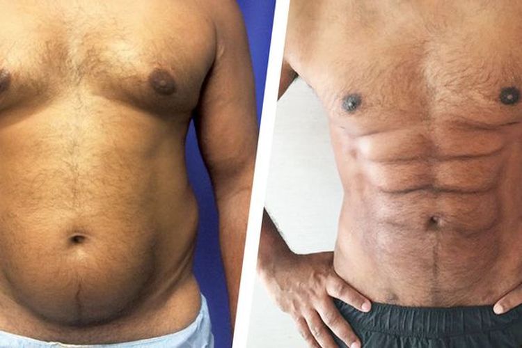 Kondisi pasien sebelum dan sesudah melakukan prosedur sedot lemak di perut