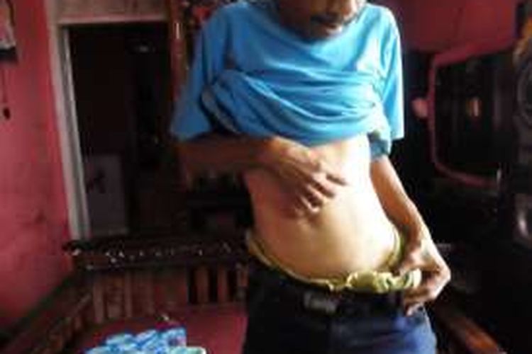 Edi Midun (39) korban penjualan ginjal saat memperlihatkan bekas operasi pencangkokan di bagian perutnya, Jum'at (29/1/2016)