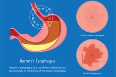 Barrett's Esophagus