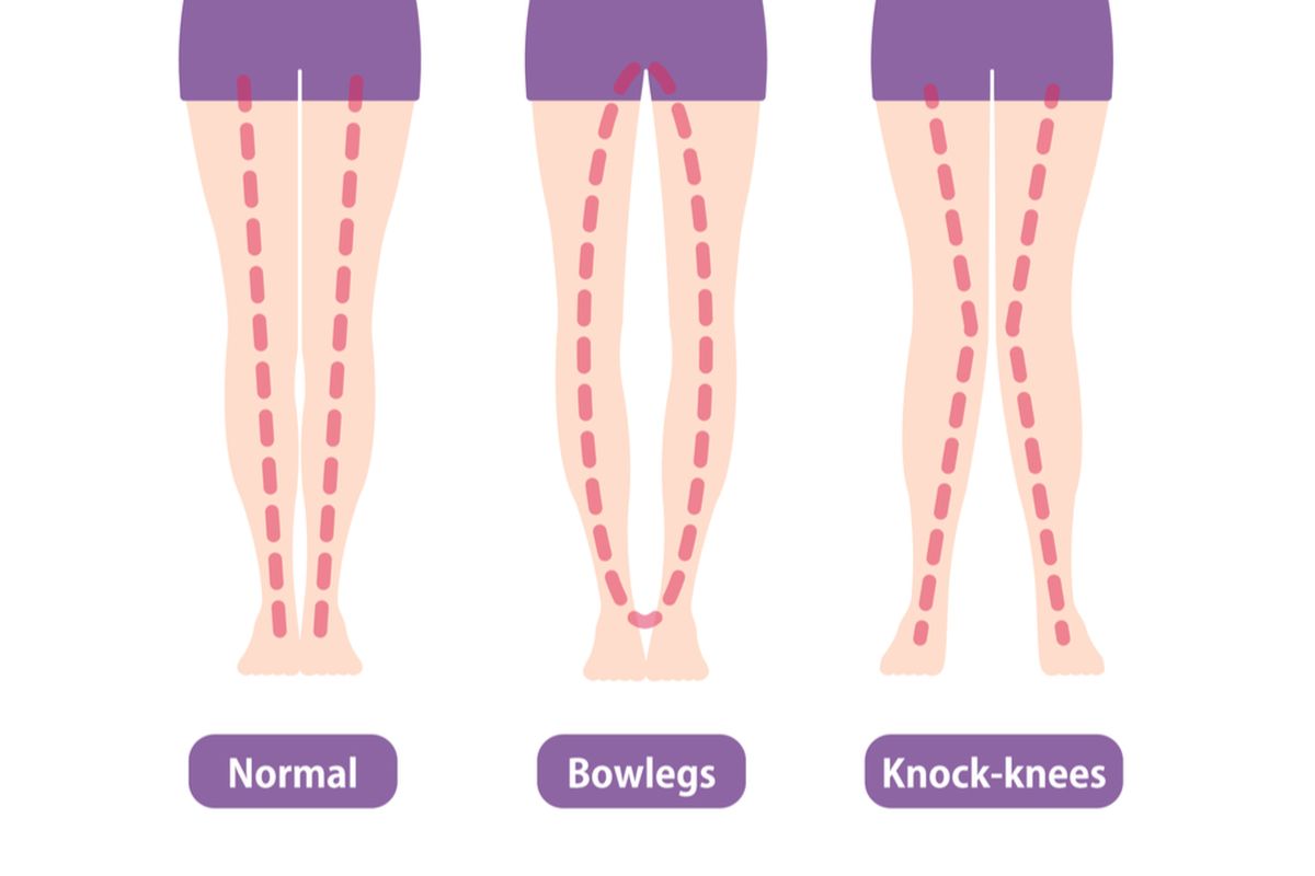 Ilustrasi kaki berbentuk X dan O, merupakan salah satu kelainan tulang yang kerap dijumpai masyarakat. Bentuk kaki yang X atau O ini terjadi karena adanya defisiensi zat gizi seperti defisiensi vitamin D atau rickets, atau adanya gangguan hormonal seperti hiperparatiroid.