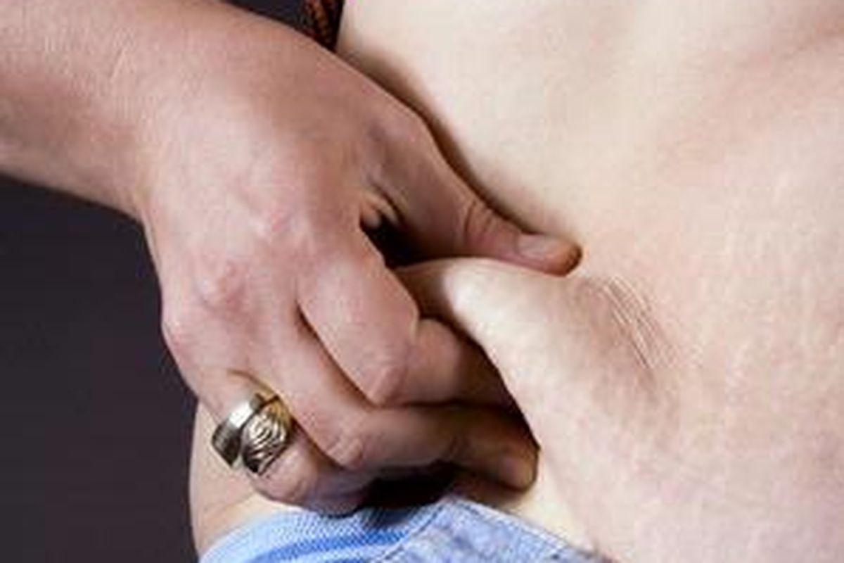 Stretch mark adalah garis-garis serupa kulit jeruk.