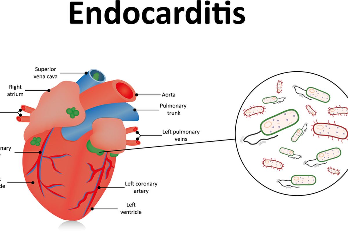 Ilustrasi Endokarditis