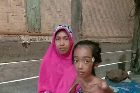 Viral Foto Bocah 11 Tahun Tinggal Tulang dan Kulit di Aceh Utara, Derita Tipes Akut