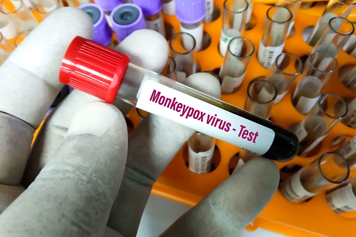 Ilustrasi sampel cacar monyet. Mutasi virus cacar monyet diduga lebih cepat dari perkiraan para ahli. Indonesia telah mengumumkan kasus pertama cacar monyet.