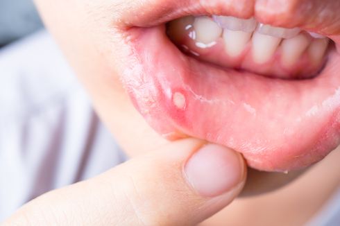 5 Cara Membedakan Sariawan dan Kanker Mulut