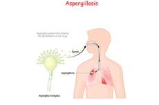 Aspergillosis