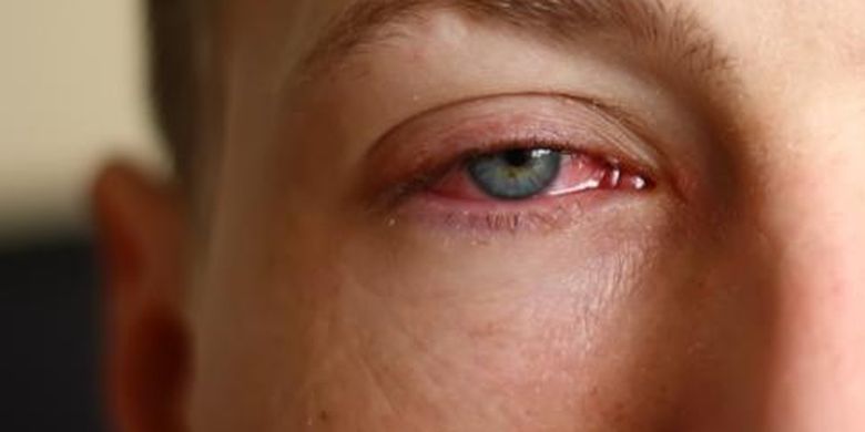 Penyakit iritasi mata disebabkan oleh