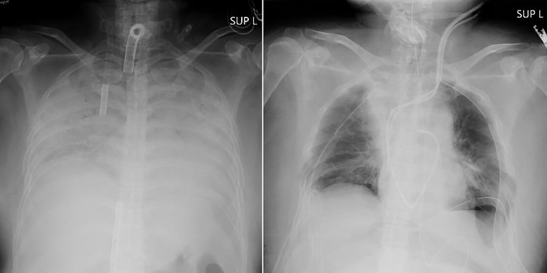 Covid-19 Patients in Japan Receive Lung Transplants from Living Donors Page all