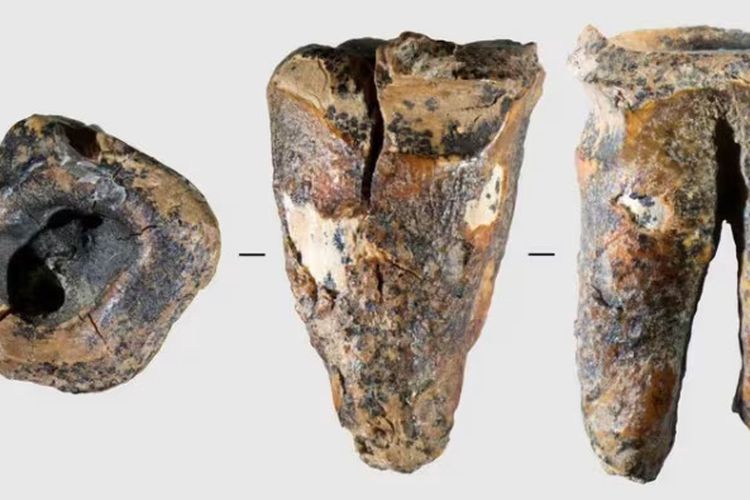 Tanpa Bius, Neanderthal Gunakan Alat Batu untuk Bor Gigi Berlubang