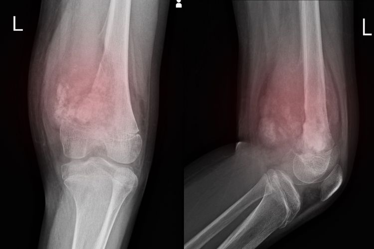 Ilustrasi gambar sinar X osteosarkoma di lutut