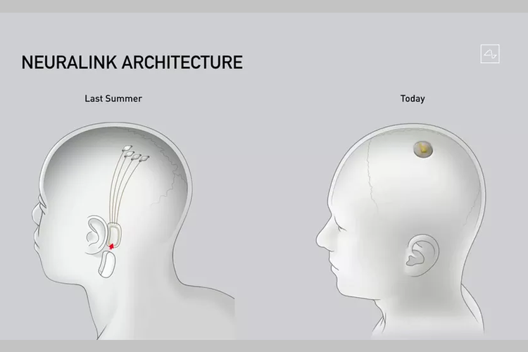 Perbedaan chip BMI Neuralink tahun lalu yang dipasang di dekat telinga (kiri) dan perangkat terbaru yang disejajarkan dengan tengkorak (kanan).