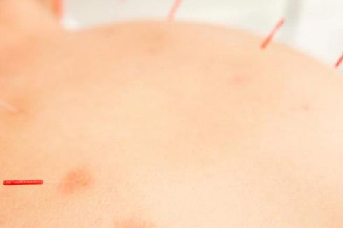 Benarkah Akupunktur Tingkatkan Kesuburan Pria?