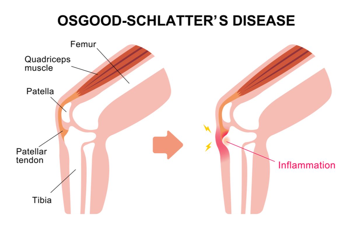 Ilustrasi penyakit Osgood-Schlatters