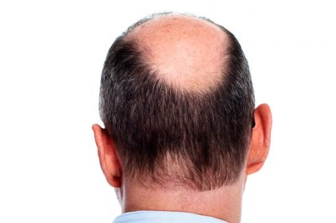 Intip Risiko Penyakit dari Kondisi Rambut