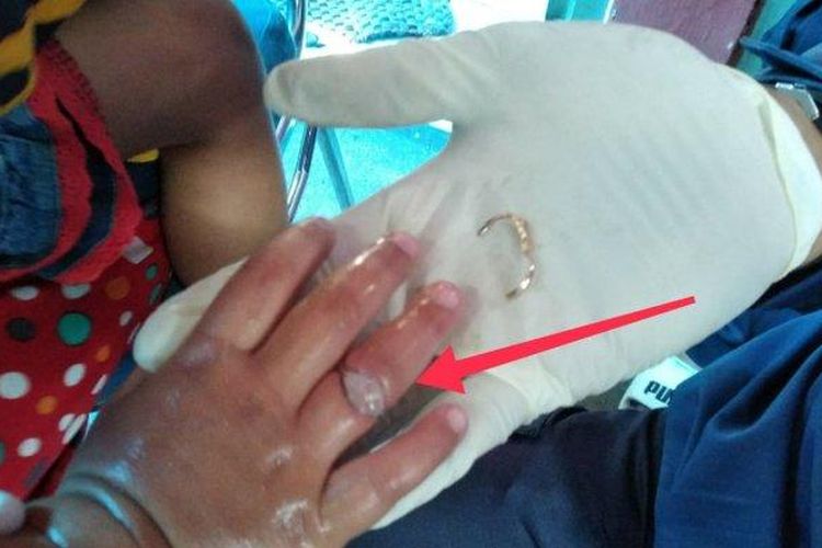 Petugas Damkar Kota Cimahi melepas cincin di jari seorang anak balita. 