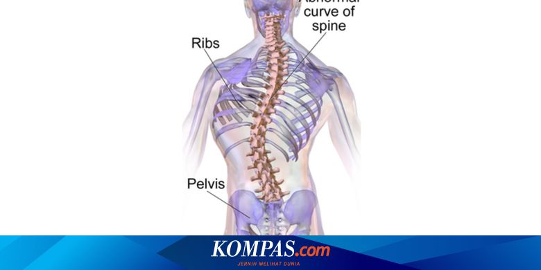 Perbedaan Skoliosis Ringan dan Parah yang Perlu Diketahui