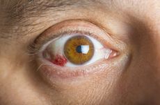 Apakah Mata Berdarah Berbahaya?