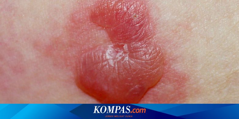 Penyakit Pemfigoid Bulosa - Gejala, Penyebab, Pengobatan - Kompas.com
