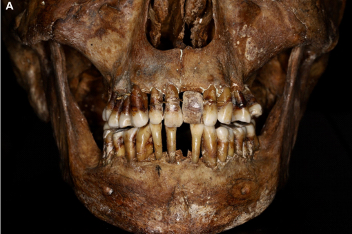 Gigi bangsawan abad ke-17. Peneliti menemukan bagaimana para bangsawan abad ke-17 melakukan perawatan gigi. Studi ini berdasarkan analisis pada jenazah ditemukan selama penggalian arkeologi di Chateau de Laval di Perancis barat laut pada tahun 1988.