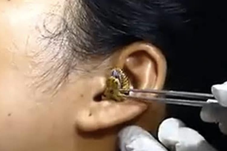 Ular terjebak di telinga wanita.