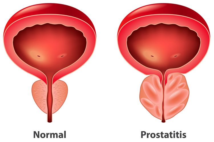 Ilustrasi prostatitis, apa itu prostatitis, gejala prostatitis, penyebab prostatitis