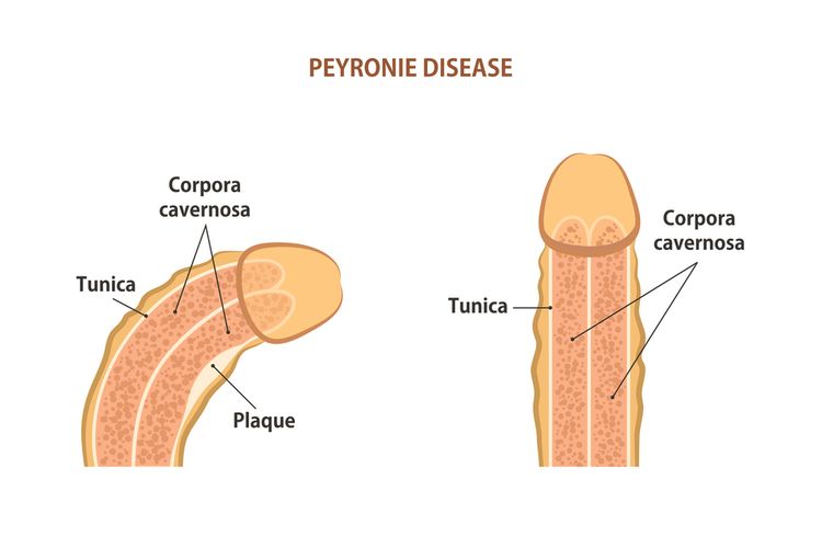 Ilustrasi Penyakit Peyronie