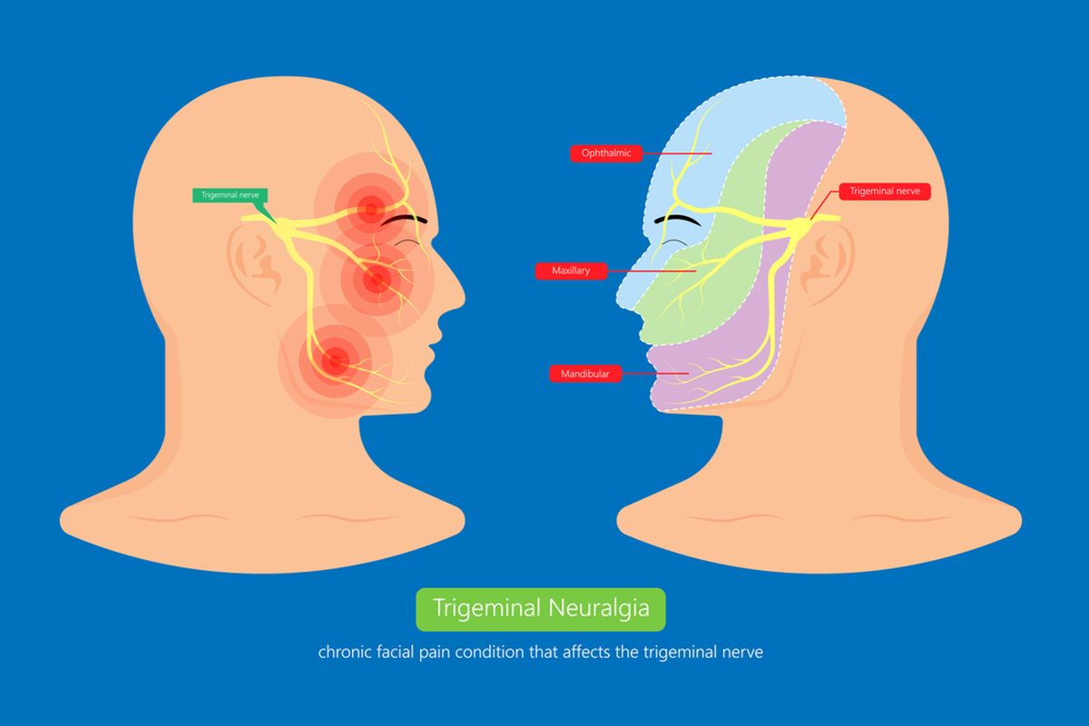 Ilustrasi Neuralgia Trigeminal