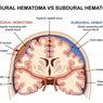 Hematoma Epidural
