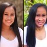 Karena Kondisi Medis Langka, Gadis 16 Tahun Ini Seperti Nenek-nenek
