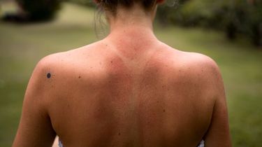 Peneliti Ungkap Rahasia di Balik Kulit Gosong Sunburn, Bukan DNA